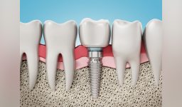 Dental Implants Explained: How They Work, The Benefits, and More