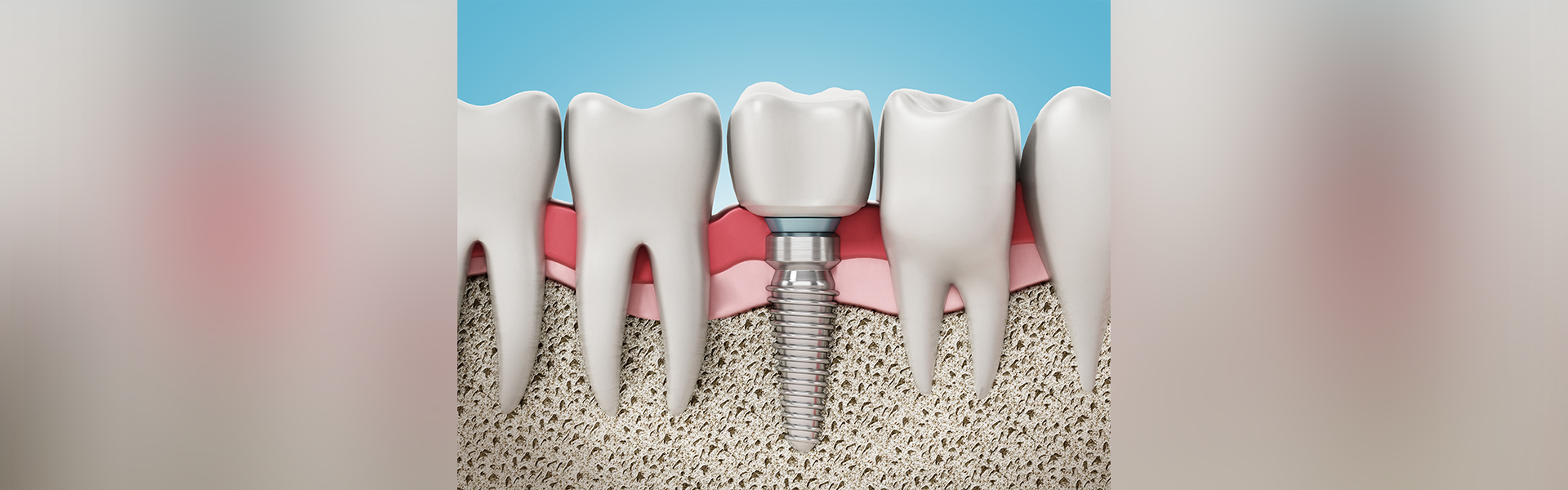 Dental Implants Explained: How They Work, The Benefits, and More