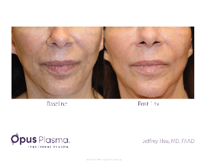 Opus Plasma Before After