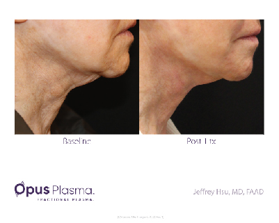 Opus Plasma Before After