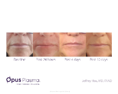 Opus Plasma Before After